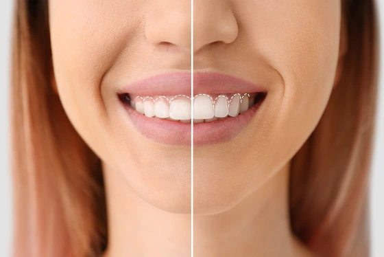 gum contouring guidelines