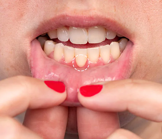 patient exposing her teeth to know if she needs gum graft in Mexico
