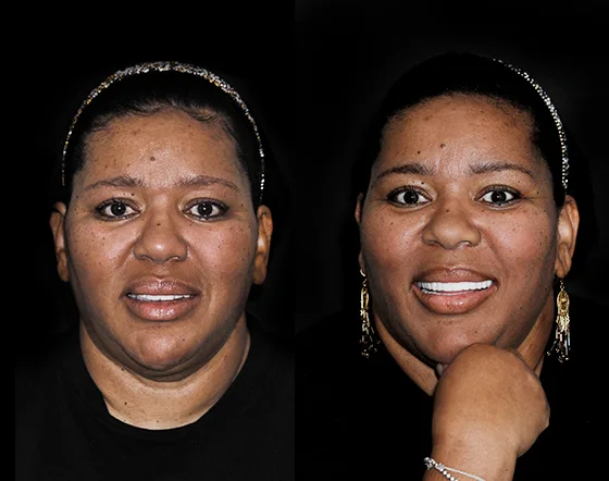 cancun dental design patients smile makeover before and after pictures