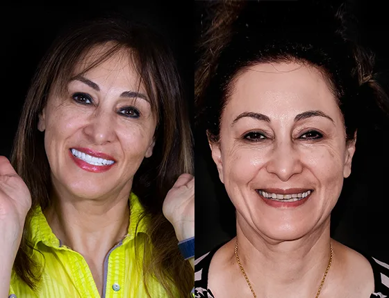 cancun dental design patients smile makeover before and after pictures